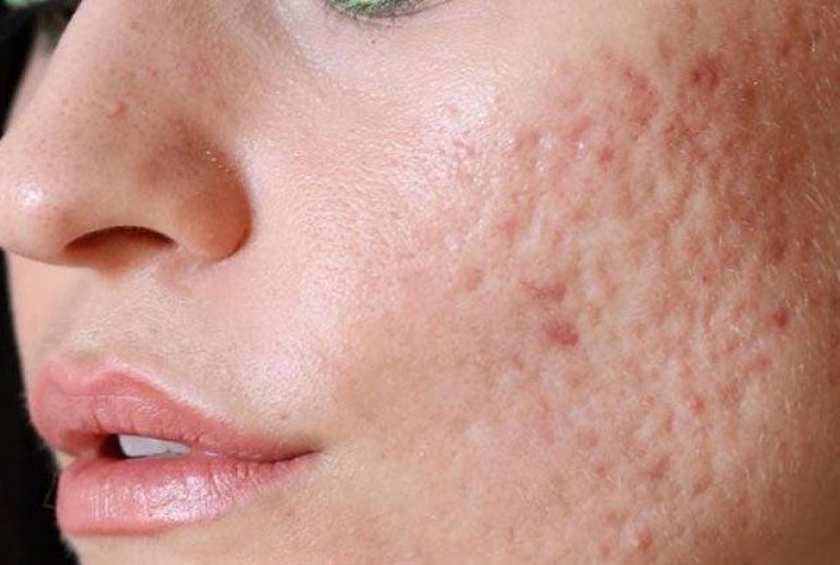 دکتر درمان اسکار آکنه در اصفهان