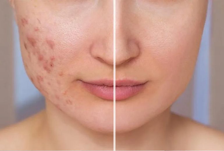 دکتر سابسیژن پوست در کرمان